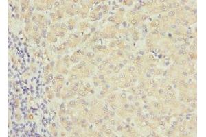 Immunohistochemistry of paraffin-embedded human liver cancer using ABIN7167233 at dilution of 1:100 (RAB17 抗体  (AA 1-212))