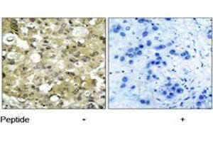 Immunohistochemical analysis of paraffin-embedded human breast carcinoma tissue using KDR polyclonal antibody  . (VEGFR2/CD309 抗体)