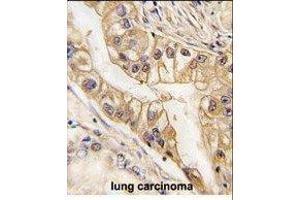 Paraformaldehyde-fixed, paraffin embedded human lung carcinoma tissue, Antigen retrieval by boiling in sodium citrate buffer (pH6. (EPH Receptor B2 抗体)