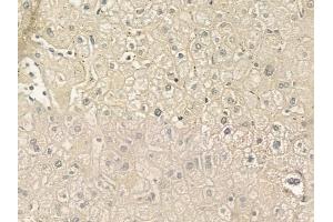 ABIN6258768 and ABIN6275107 at 1/100 staining human hepatocellular carcinoma by IHC-P.