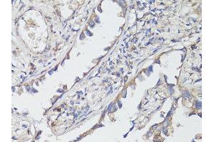 Immunohistochemistry of paraffin-embedded human lung cancer using NTRK2 antibody (ABIN5998390) at dilution of 1/200 (40x lens). (TRKB 抗体)