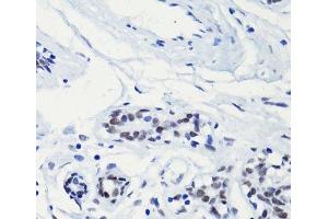 Immunohistochemistry of paraffin-embedded Human breast using Acetyl-Histone H2A-K5 Polyclonal Antibody at dilution of 1:100 (40x lens). (Histone H2A 抗体  (acLys5))