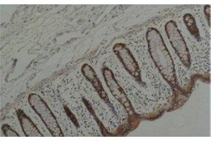 Immunohistochemistry of paraffin-embedded Human colon carcinoma tissue using HSP90 alpha Monoclonal Antibody at dilution of 1:200.