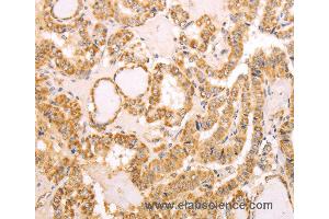 Immunohistochemistry of Human thyroid cancer using NAMPT Polyclonal Antibody at dilution of 1:30 (NAMPT 抗体)