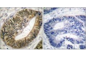 Immunohistochemistry analysis of paraffin-embedded human colon carcinoma, using SEPARASE (Phospho-Ser801) Antibody. (Separase 抗体  (pSer801))