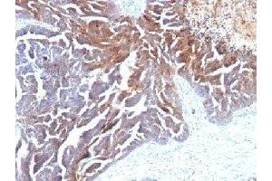 Formalin-fixed, paraffin-embedded human ovarian carcinoma stained with TAG-72 antibody (B72. (TAG-72 抗体)