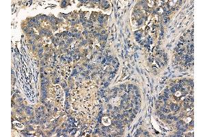 ABIN7095451 and ABIN7099508 at 1/100 staining human lung cancer by IHC-P.