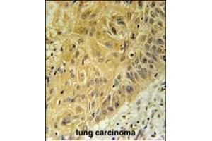 WNT5A Antibody (Center) (ABIN651869 and ABIN2840430) immunohistochemistry analysis in formalin fixed and paraffin embedded human lung carcinoma followed by peroxidase conjugation of the secondary antibody and DAB staining. (WNT5A 抗体  (AA 185-213))