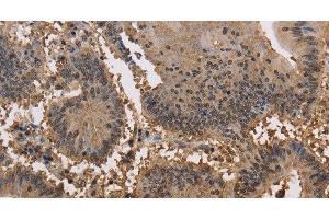 Immunohistochemistry of paraffin-embedded Human colon cancer tissue using JAG2 Polyclonal Antibody at dilution 1:30 (JAG2 抗体)