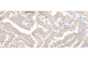 Immunohistochemistry of paraffin-embedded Human thyroid cancer tissue using ACSF2 Polyclonal Antibody at dilution of 1:30(x200) (ACSF2 抗体)