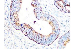 Immunohistochemistry of paraffin-embedded human colon carcinoma using PDHB Rabbit mAb (ABIN7269772) at dilution of 1:100 (40x lens). (PDHB 抗体)