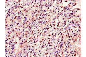 Immunohistochemistry of paraffin-embedded human lung cancer using ABIN7144222 at dilution of 1:100 (ANKRD23 抗体  (AA 1-200))