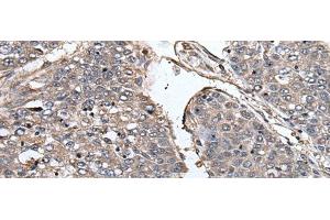 Immunohistochemistry of paraffin-embedded Human liver cancer tissue using PRUNE Polyclonal Antibody at dilution of 1:40(x200) (PRUNE 抗体)
