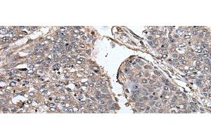 Immunohistochemistry of paraffin-embedded Human liver cancer tissue using PRUNE Polyclonal Antibody at dilution of 1:40(x200)