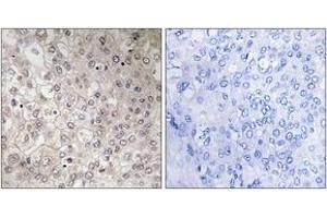 Immunohistochemistry analysis of paraffin-embedded human liver carcinoma tissue, using GIPR Antibody. (GIPR 抗体  (AA 93-142))