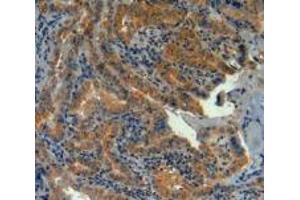 IHC-P analysis of Human Thyroid Cancer Tissue, with DAB staining. (LPCAT3 抗体  (AA 122-233))
