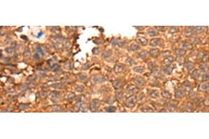 Immunohistochemistry of paraffin-embedded Human ovarian cancer tissue using HOXD8 Polyclonal Antibody at dilution of 1:40(x200)
