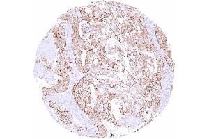 Clear cell ovarian carcinoma with moderate occludin staining of tumor cells (Occludin 抗体  (AA 282-415))