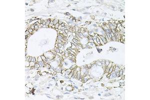 Immunohistochemistry of paraffin-embedded human gastric cancer using B1 antibody (ABIN6127389, ABIN6137306, ABIN6137309 and ABIN6221475) at dilution of 1:100 (40x lens). (ATP1B1 抗体  (AA 63-303))