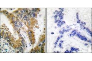Immunohistochemistry analysis of paraffin-embedded human lung carcinoma tissue, using CrkL (Ab-207) Antibody. (CrkL 抗体  (AA 173-222))