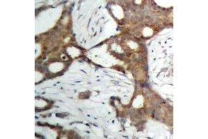 Immunohistochemical analysis of Androgen Receptor staining in human prostate cancer formalin fixed paraffin embedded tissue section.