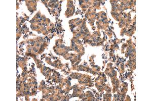 Immunohistochemistry of Human liver cancer using CGA Polyclonal Antibody at dilution of 1:65 (hCG 抗体)