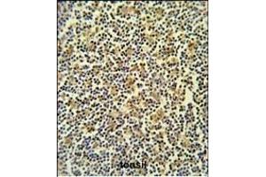 CORO6 Antibody (C-term) (ABIN651024 and ABIN2840040) IHC analysis in formalin fixed and paraffin embedded lymph carcinoma followed by peroxidase conjugation of the secondary antibody and DAB staining. (Coronin 6 抗体  (C-Term))