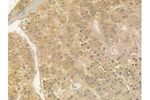 ABIN6264117 and ABIN6274083 at 1/100 staining human hepatocellular carcinoma by IHC-P.