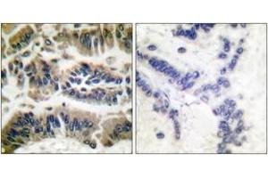 Immunohistochemistry analysis of paraffin-embedded human breast carcinoma tissue, using Caspase 6 (Ab-257) Antibody.