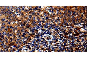 Immunohistochemistry of paraffin-embedded Human tosil tissue using IL13RA1 Polyclonal Antibody at dilution 1:50 (IL13 Receptor alpha 1 抗体)