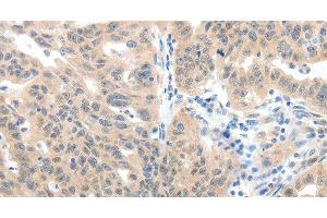 Immunohistochemistry of paraffin-embedded Human ovarian cancer tissue using SLC20A1 Polyclonal Antibody at dilution 1:40 (SLC20A1 抗体)