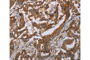 Immunohistochemistry of Human breast cancer using PLXNB1 Polyclonal Antibody at dilution of 1:50 (PLXNB1 抗体)