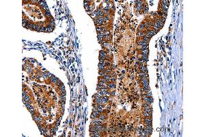 Immunohistochemistry of Human esophagus cancer using ITGA7 Polyclonal Antibody at dilution of 1:35 (ITGA7 抗体)