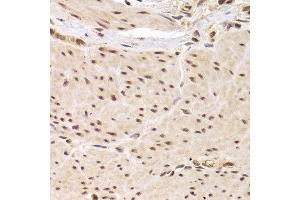 Immunohistochemistry of paraffin-embedded Human gastric cancer using RBPJ antibody at dilution of 1:100 (x40 lens). (RBPJ 抗体)
