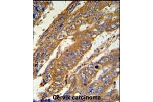 PAN3 Antibody IHC analysis in formalin fixed and paraffin embedded human cervix carcinoma followed by peroxidase conjugation of the secondary antibody and DAB staining. (PAN3 抗体  (C-Term))