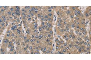Immunohistochemistry of paraffin-embedded Human liver cancer tissue using IRAK4 Polyclonal Antibody at dilution 1:40 (IRAK4 抗体)