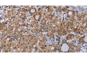 Immunohistochemistry of paraffin-embedded Human thyroid cancer tissue using LIMK1 Polyclonal Antibody at dilution 1:40 (LIM Domain Kinase 1 抗体)