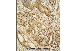 MCM2 Antibody (C-term) (ABIN653324 and ABIN2842815) immunohistochemistry analysis in formalin fixed and paraffin embedded human colon carcinoma followed by peroxidase conjugation of the secondary antibody and DAB staining. (MCM2 抗体  (C-Term))