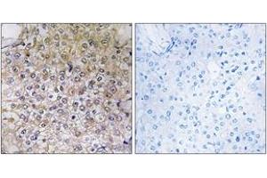 Immunohistochemistry analysis of paraffin-embedded human breast carcinoma tissue, using ATP6V1B1 Antibody. (ATP6V1B1 抗体  (AA 381-430))