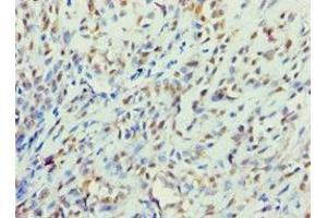 Immunohistochemistry of paraffin-embedded human breast cancer using ABIN7145241 at dilution of 1:100 (BBS4 抗体  (AA 350-519))