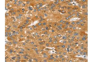 The image on the left is immunohistochemistry of paraffin-embedded Human liver cancer tissue using ABIN7192646(SRGAP2 Antibody) at dilution 1/20, on the right is treated with synthetic peptide. (SRGAP2 抗体)