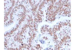 Formalin-fixed, paraffin-embedded human Colon Carcinoma stained with NRF1 Mouse Monoclonal Antibody (NRF1/2608). (NFE2L1 抗体)