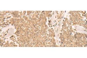 Immunohistochemistry of paraffin-embedded Human lung cancer tissue using IL1RAPL2 Polyclonal Antibody at dilution of 1:25(x200)