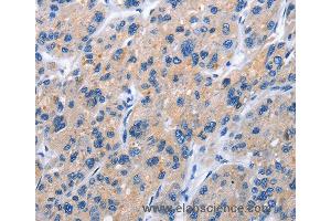 Immunohistochemistry of Human gastric cancer using TNFRSF9 Polyclonal Antibody at dilution of 1:40 (CD137 抗体)