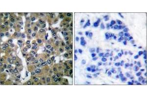 Immunohistochemistry analysis of paraffin-embedded human breast carcinoma tissue, using PLCG2 (Ab-753) Antibody. (Phospholipase C gamma 2 抗体  (AA 721-770))