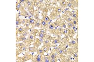 Immunohistochemistry of paraffin-embedded human liver injury using GPD2 Antibody. (GPD2 抗体  (AA 25-325))