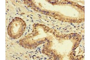 Immunohistochemistry of paraffin-embedded human prostate cancer using ABIN7165398 at dilution of 1:100 (FAM135B 抗体  (AA 801-1100))