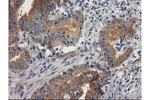 Immunohistochemical staining of paraffin-embedded Adenocarcinoma of Human colon tissue using anti-BCAR1 mouse monoclonal antibody. (BCAR1 抗体)