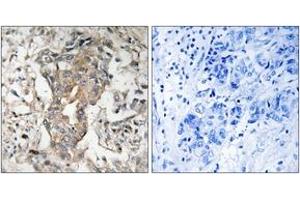 Immunohistochemistry analysis of paraffin-embedded human breast carcinoma tissue, using SPHK2 (Ab-614) Antibody. (SPHK2 抗体  (AA 580-629))