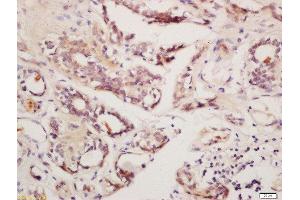 Formalin-fixed and paraffin embedded human breast cancer labeled with Rabbit Anti-GnRHR Polyclonal Antibody, Unconjugated  at 1:200, followed by conjugation to the secondary antibody and DAB staining (GNRHR 抗体  (AA 201-328))
